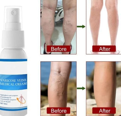 Varicose Vein Cream Spray Varicose Vein Legs and Varicose Vein Swelling L3g1 (Pack of 2)